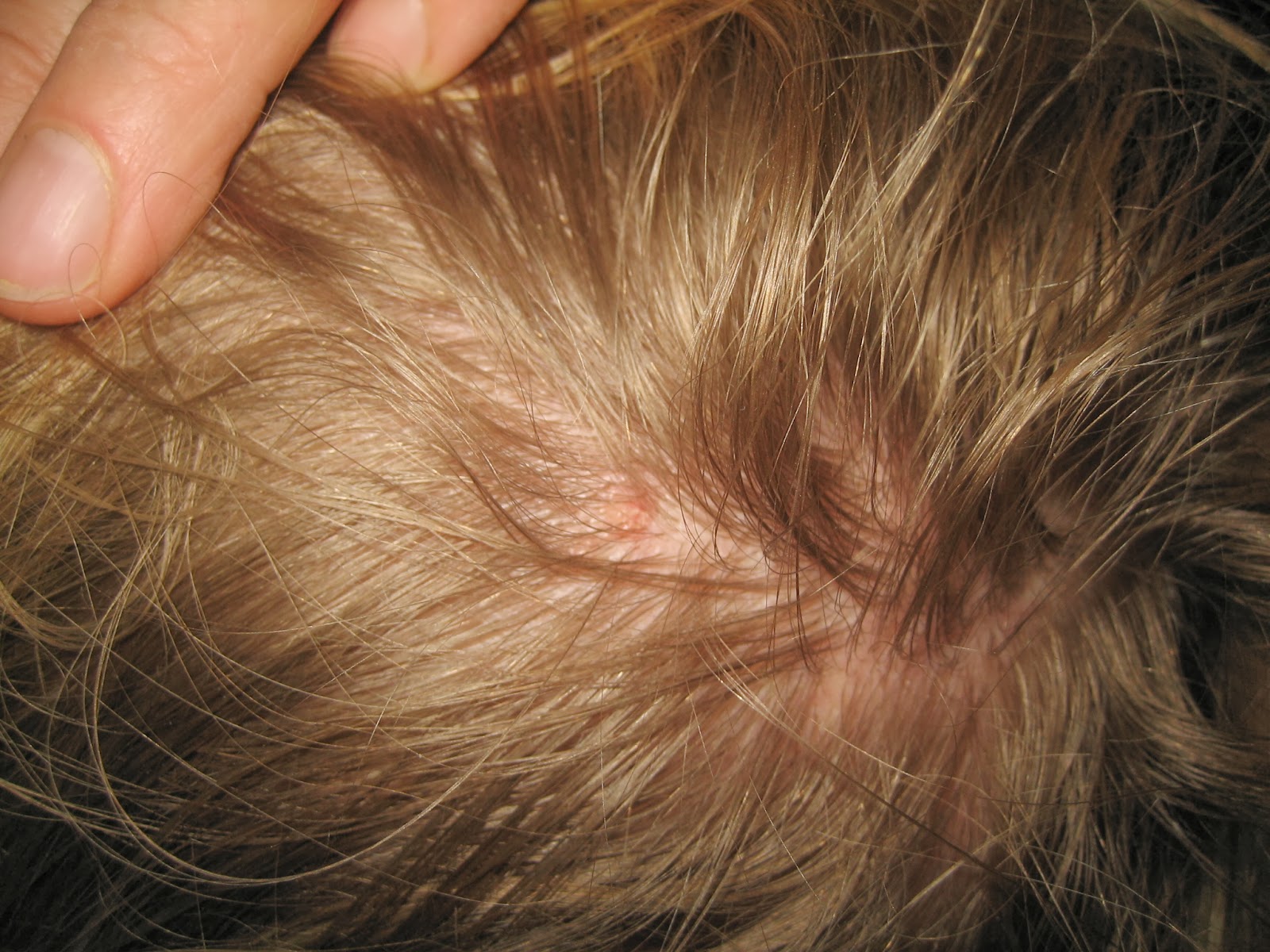 Pictures: How Do You Treat and Prevent Head Lice? - WebMD